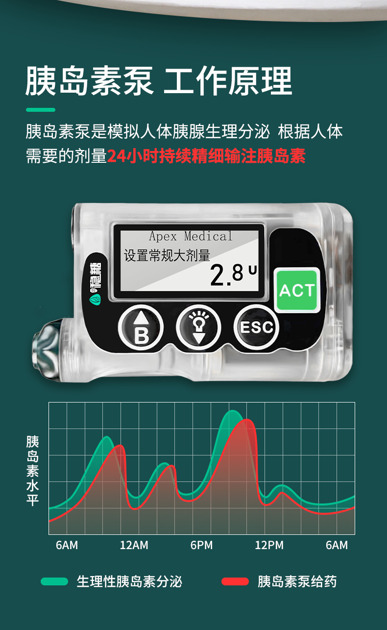 最新全自動(dòng)胰島素泵，糖尿病管理的革命性進(jìn)步，全自動(dòng)胰島素泵，糖尿病管理的突破性革新