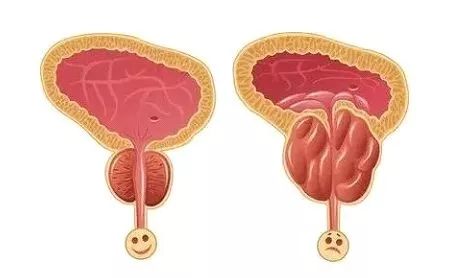 老公的前列腺增大挑戰(zhàn)，理解、支持與共同對(duì)抗，老公前列腺增大，理解、支持與共同應(yīng)對(duì)的挑戰(zhàn)