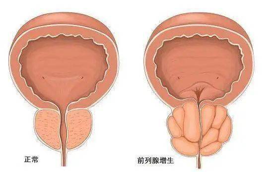 前列腺鈣化，一種常見的前列腺疾病及其相關(guān)知識解析，前列腺鈣化解析，常見疾病與相關(guān)知識探討