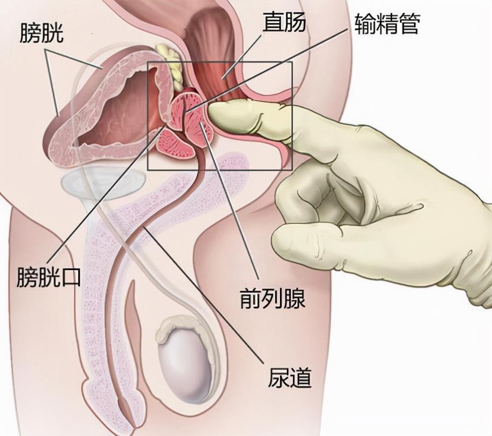 前列腺炎，重新認識男性健康的誤區(qū)，重新認識男性健康誤區(qū)，前列腺炎解析