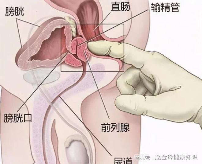 慢性前列腺炎，能否徹底治愈？解析與探討，慢性前列腺炎的治愈可能性解析與探討