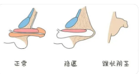 關(guān)于做包皮手術(shù)的費(fèi)用分析，包皮手術(shù)費(fèi)用詳解