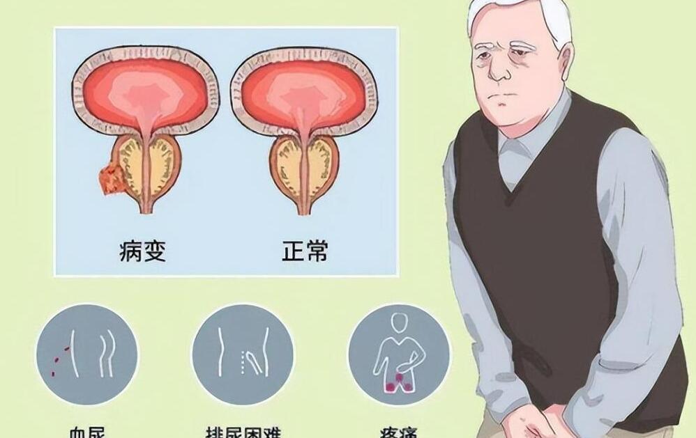 年輕人得了前列腺增大，理解、應(yīng)對與關(guān)注，年輕人前列腺增大，理解、應(yīng)對與關(guān)注的重要性