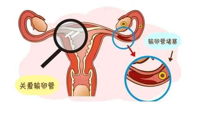 輸卵管堵塞的癥狀表現(xiàn)與解析，輸卵管堵塞的癥狀、表現(xiàn)與解析