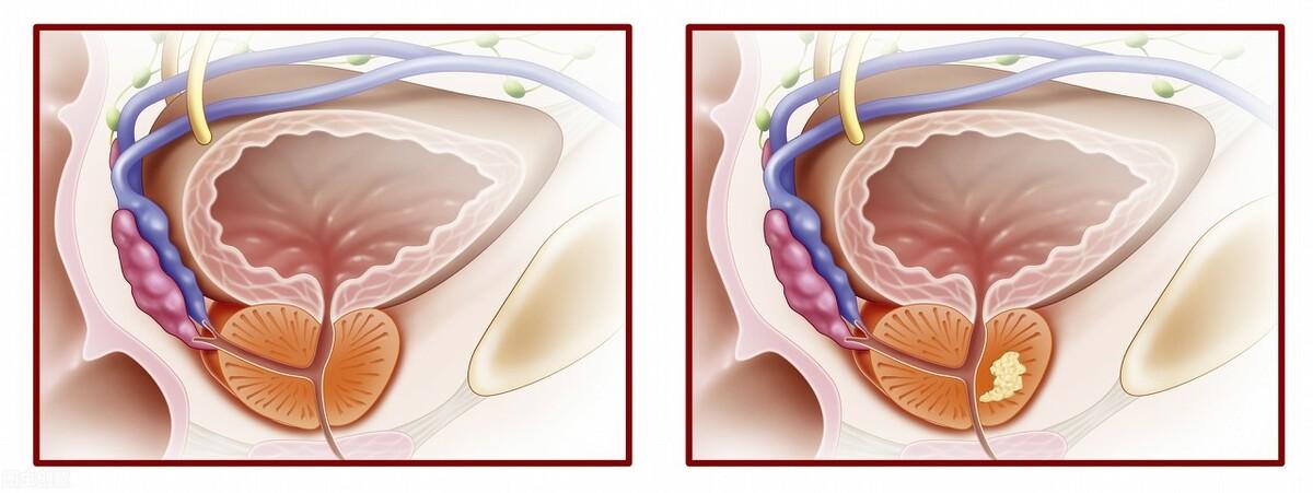 前列腺鈣化，揭示其潛在危害，前列腺鈣化，潛在危害揭秘