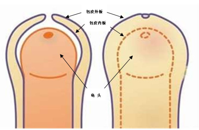 包莖及其相關(guān)圖片，了解、識(shí)別與處理，包莖詳解，圖片、識(shí)別、處理方法全攻略