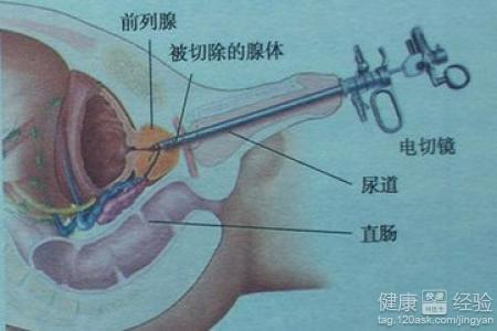 如何控制前列腺增生，如何控制前列腺增生的發(fā)展及癥狀？