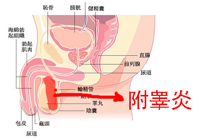 附睪炎，絕望中的希望曙光，附睪炎，絕望中的希望之光